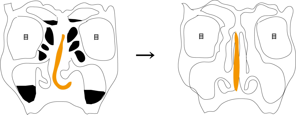 副 鼻腔 炎 手術 ブログ